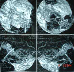 脑血管造影 脑血管造影 全脑血管造影术与3D旋转技术应用