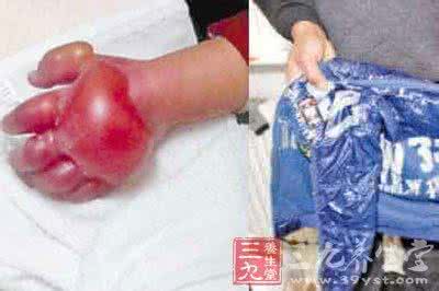 冻伤疤痕怎么去掉 冻伤男孩 冬季如何预防冻伤