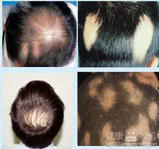 斑秃病因及治疗 斑秃病因及治疗 斑秃的病因与临床表现 治疗