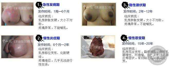 隆胸的危害有哪些 隆胸的危害 隆胸危害