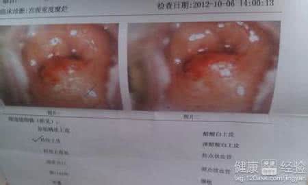 宫颈糜烂需要手术吗 宫颈糜烂 宫颈糜烂手术