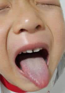 咽炎偏方大全 治疗咽炎咳嗽偏方大全 咽炎怎么办?治疗咽炎偏方大全