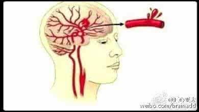 高血压脑出血发病率 高血压脑出血发病时的前兆