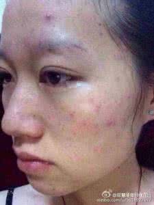 土豆祛痘的小窍门 成慧媚告别痘豆脸 告别红“痘”脸 还原无瑕肌