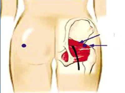 梨状肌综合征的特点是 梨状肌综合征是个什么鬼？