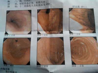 慢性浅表性胃炎伴糜烂 浅表性胃炎伴糜烂 别让胃炎发展成糜烂
