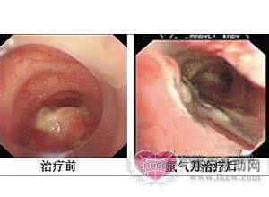 支气管肿瘤是肺癌吗 气管肿瘤是肺癌吗？