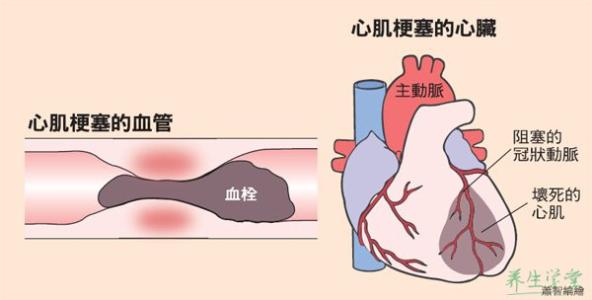 心梗的病因 大面积心梗有哪些病因