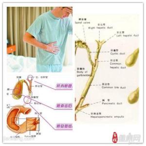 胆囊息肉原因 胆囊息肉原因 4个因素会导致胆囊息肉