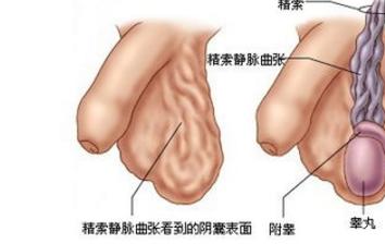 男性睾丸炎的预防 男性睾丸炎的预防 男性睾丸炎的预防和保健方法