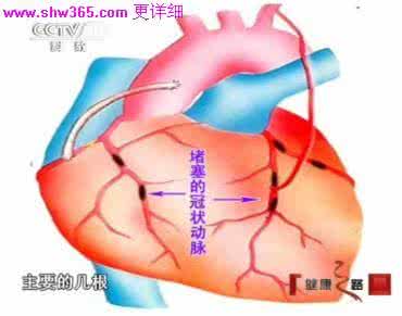 早期冠心病如何治疗 一张图告诉你冠心病的病症、治疗和预防