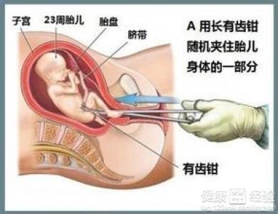 做堕胎的注意事项 堕胎以后的注意事项