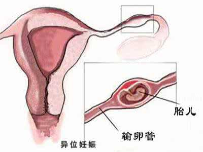 宫外孕是怎么导致的 致命女杀手 炎症导致宫外孕，女人致命杀手