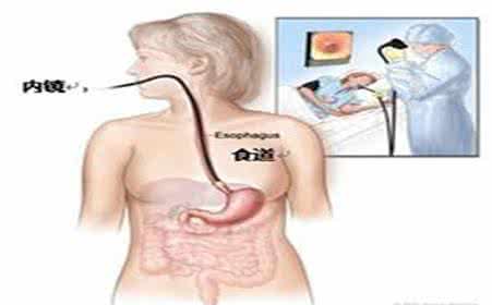 食道癌扩散还能活多久 食道癌扩散还能活多久 食道癌中期会扩散多吗？