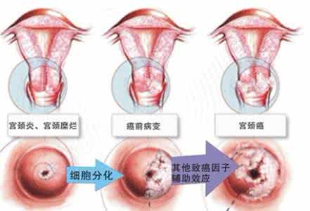 宫颈炎症如何治疗 宫颈炎症 宫颈炎症如何预防