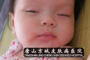 宝宝皮肤过敏症状图片 宝宝皮肤过敏的症状是怎样 需要注意哪些饮食