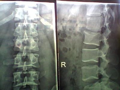 治骨质增生特效方 专治骨质增生特效方*