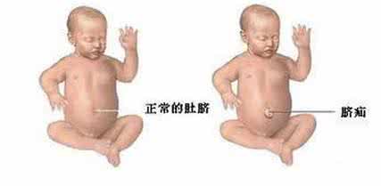 脐疝是什么意思 小儿脐疝的病因 多数是先天原因