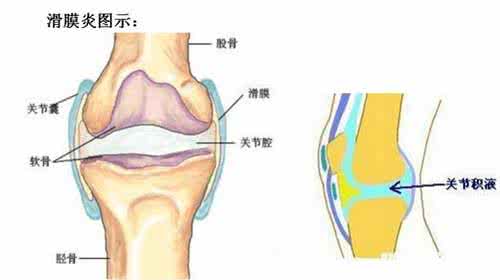 滑膜炎怎么治疗最有效 滑膜炎怎么治疗最有效 滑膜炎的治疗方案