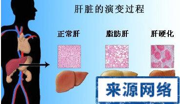 预防脂肪肝的方法 怎样预防脂肪肝 远离这6点很重要