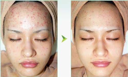 果酸换肤后脸好可怕 果酸换肤脸会发红吗？