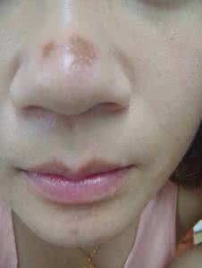 美容院挤黑头 美容院挤黑头能好吗?
