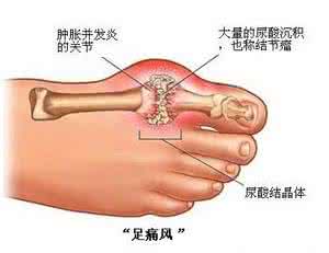 痛风性关节炎 痛风性关节炎 患上痛风关节疼！它俩泡水喝是正道