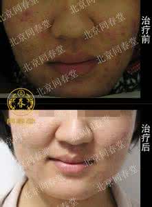 面部痤疮的治疗方法 面部痤疮怎么医治 什么方法