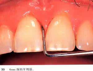 牙酸最快的治疗方法 牙酸蚀病如何治疗