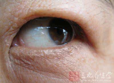 白内障手术后视力模糊 视物模糊不要全归罪于白内障