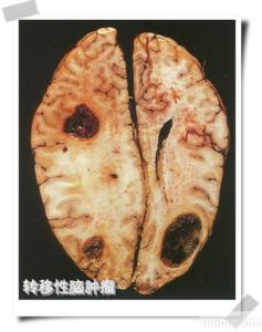 脑肿瘤 脑肿瘤或脑转移瘤疼痛--蝎麻散