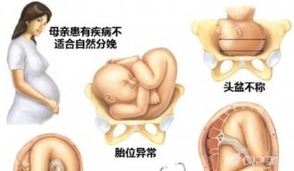 剖宫产和顺产的区别 顺产剖宫产有什么区别