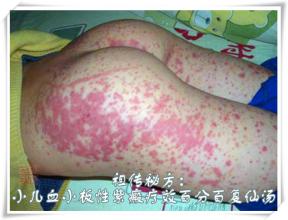 小儿过敏性紫癜 祖传秘方：小儿过敏性紫癜百治百愈加味四味汤