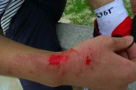 皮肤擦伤不能吃什么 皮肤擦伤可以吃鸽子吗？