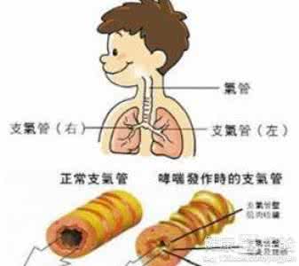 支气管炎怎么注意饮食 支气管炎怎么治 支气管炎的饮食注意事项