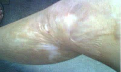 烧烫伤疤痕治疗 烫伤疤痕 烧伤疤痕