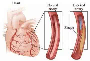 打通血管血栓绝密配方 打通血栓血管绝密配方