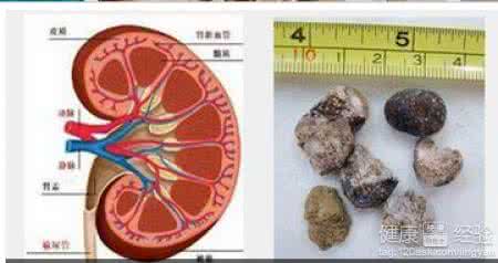 肾结石治疗方法 肾结石治疗 这些方法可以治愈肾结石