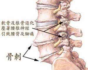 腰椎突出最好的治疗 热敷疗法治疗腰椎骨质增生90例