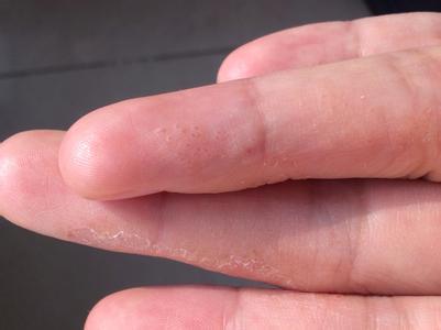 荨麻疹最快治疗方法 荨麻疹传染吗