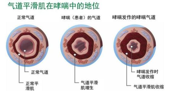气管炎哮喘特效药 治重症哮喘可用支气管热成形术