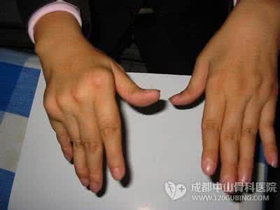风湿关节炎早期症状 风湿性关节炎症状 这些方法判断风湿关节炎