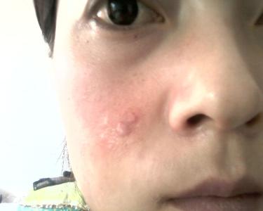 痤疮感染了怎么办 痤疮感染怎么办