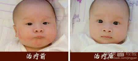 小儿过敏性湿疹 小儿湿疹不用愁，轻轻摸摸就能走