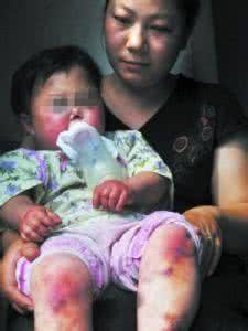 免疫性血小板减少紫癜 免疫性血小板减少性紫癜 这个疾病的概述