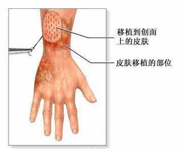 皮肤移植手术多少钱 皮肤移植 皮肤移植手术