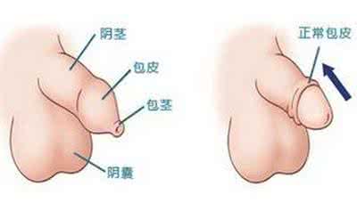 男人因包皮过长导致早泄如何治疗