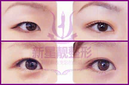 做埋线双眼皮手术 做双眼皮手术注意事项 埋线双眼皮手术的一些注意事项