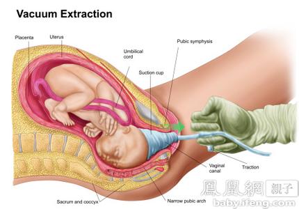 顺产开产道过程图 大龄女性孕前须重视产道健康