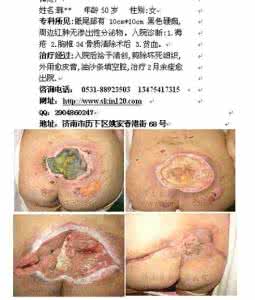 肺癌早期症状 肺癌的早期症状 肺癌的8个早期症状，早点知道能救你的命！